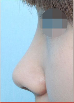 낮은코 전후사진