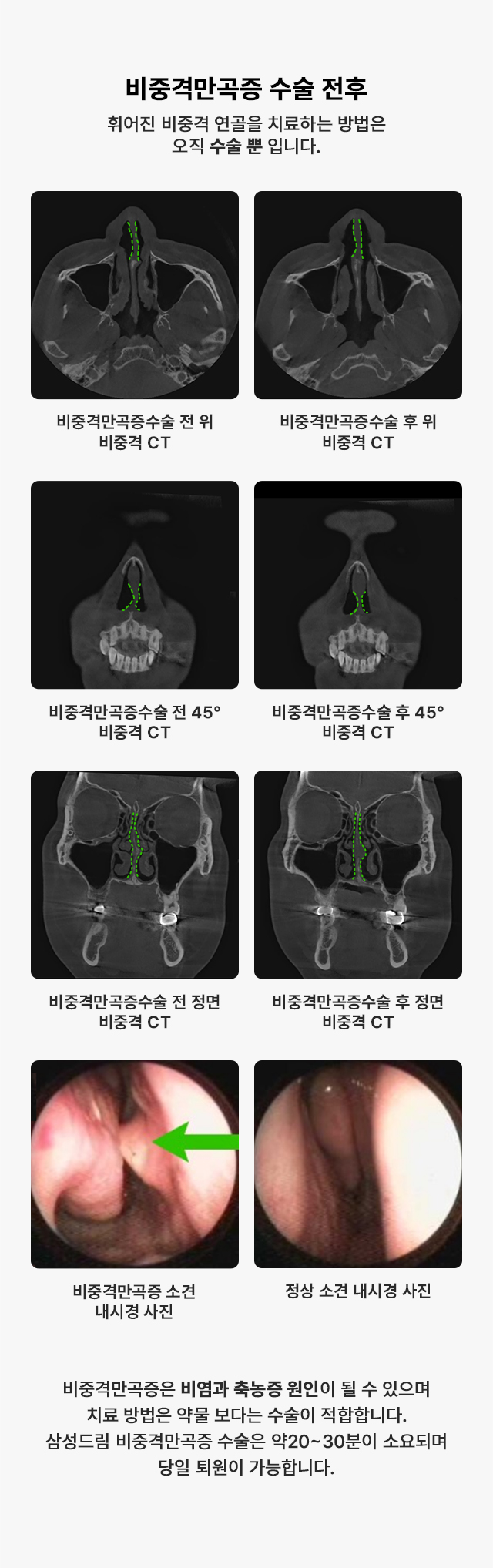 비중격만곡증 수술전후