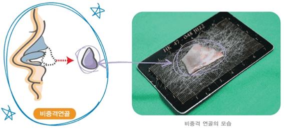 휜코교정